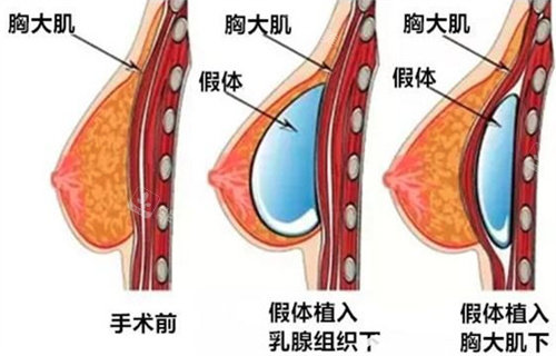 胸大肌植入法