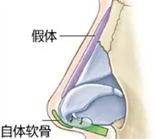 韩国mind整形正规吗？