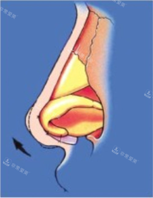 鼻子形态图