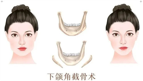 下颌角截骨术前后对比图 下颌角截骨术前后对比图
