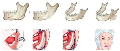 磨骨手术流程展示图