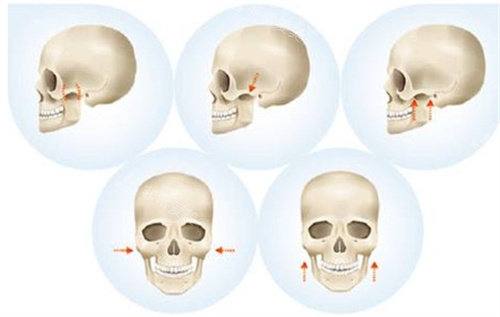 顴骨縮小手術動畫圖