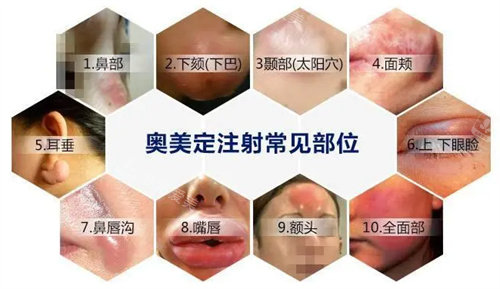 常见奥美定注射部位图 常见奥美定注射部位图