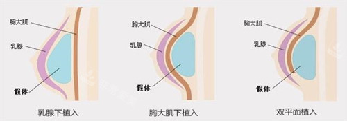 不同植入假体方法照片