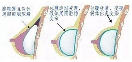 胸部包膜攣縮變化圖片 胸部包膜攣縮變化圖片