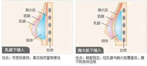 不同植入方法图片