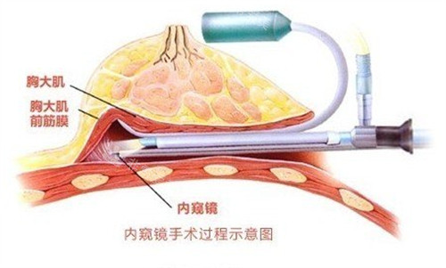 內(nèi)窺鏡手術(shù)圖片