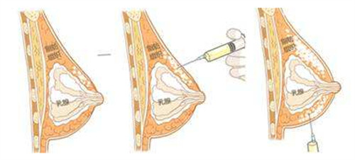 自体脂肪植入胸部图片