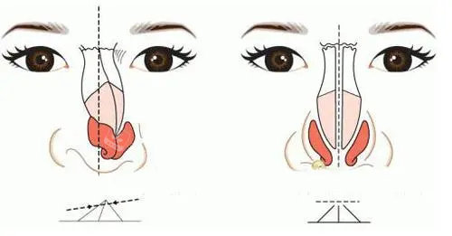 正常鼻型与歪鼻对比图片