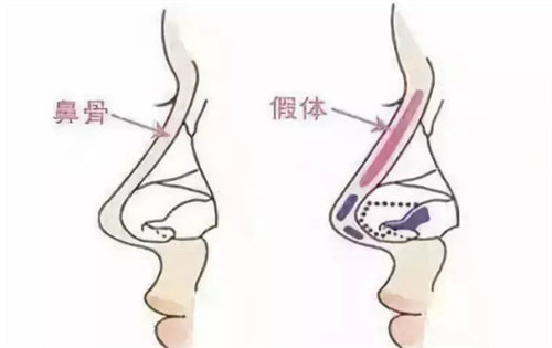 假体填入位置图片