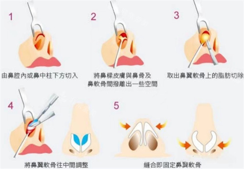 探索鼻翼宽大怎么改善！