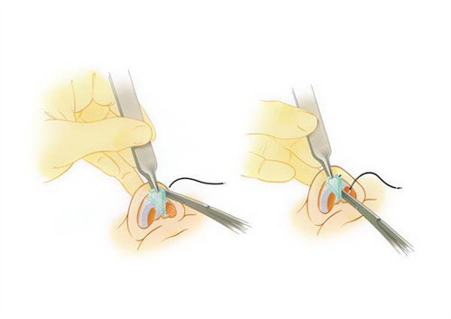 讲讲隆鼻手术材料都有哪些！