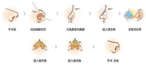 隆鼻手术过程图片