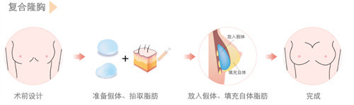 复合式隆胸手术图