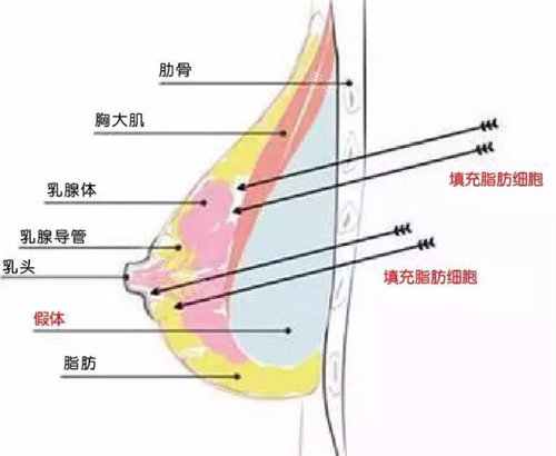复合式隆胸形象图