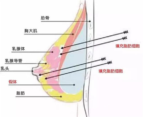復(fù)合式隆胸形象圖