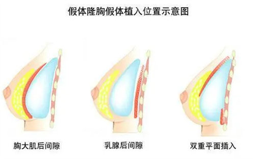 假体隆胸位置示意图