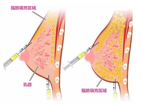 脂肪隆胸圖