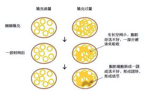 自體脂肪填充圖