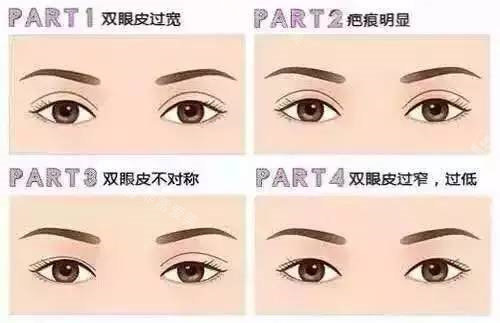 雙眼皮問(wèn)題圖片 雙眼皮問(wèn)題圖片