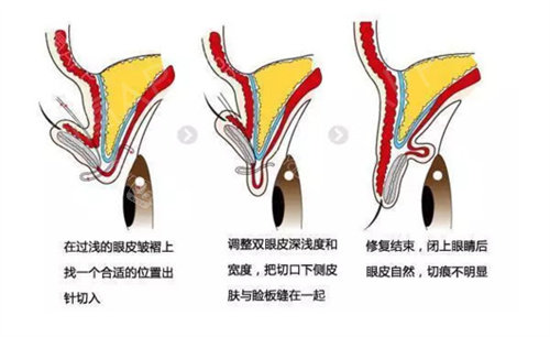 双眼皮手术过程图片