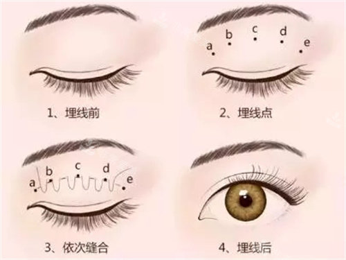 双眼皮手术埋线法图片