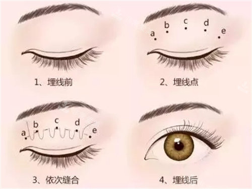 雙眼皮手術(shù)埋線法圖片 雙眼皮手術(shù)埋線法圖片
