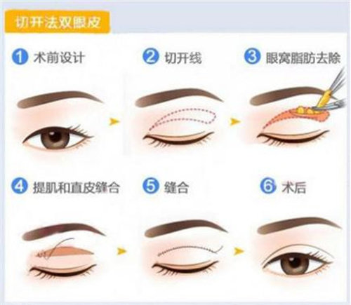 雙眼皮切開(kāi)法手術(shù)圖片 雙眼皮切開(kāi)法手術(shù)圖片