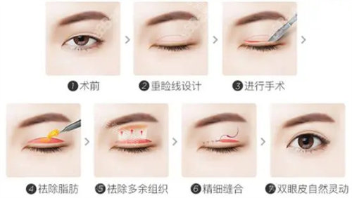 雙眼皮手術(shù)過(guò)程圖片