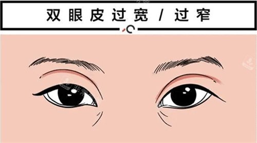 雙眼皮過(guò)寬/過(guò)窄圖片
