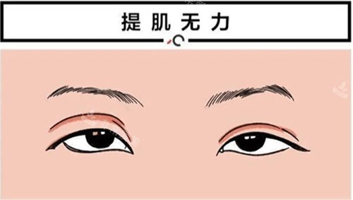 雙眼皮提肌無(wú)力圖片