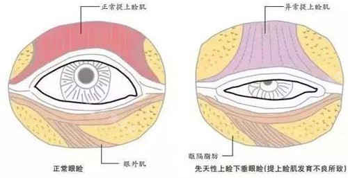 眼皮下垂内部组织图片