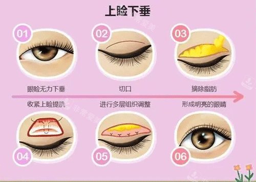 上瞼下垂手術(shù)過(guò)程圖片