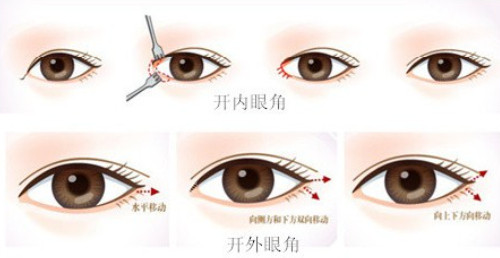 開(kāi)內(nèi)眼角與外眼角手術(shù)位置 開(kāi)內(nèi)眼角與外眼角手術(shù)位置