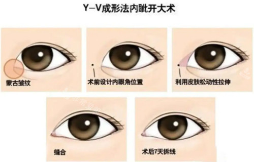 y-v縫合法圖片 y-v縫合法圖片