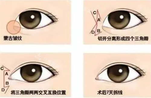 四辦法手術(shù)圖片 四辦法手術(shù)圖片