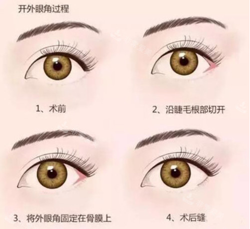 開(kāi)外眼角手術(shù)過(guò)程圖片 開(kāi)外眼角手術(shù)過(guò)程圖片