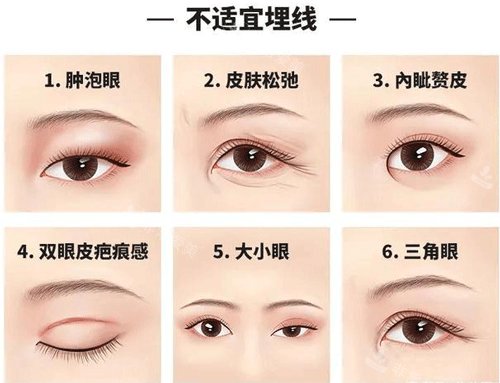 不適合埋線的眼型圖片 不適合埋線的眼型圖片