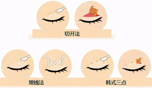 三种不同双眼皮手术方式图片