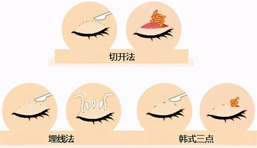 三種不同雙眼皮手術(shù)方式圖片 三種不同雙眼皮手術(shù)方式圖片