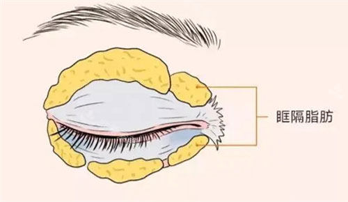 眶隔脂肪图片