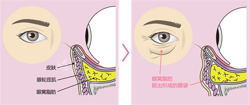 眼袋手术的外切与内切 讲述两者不同之处！