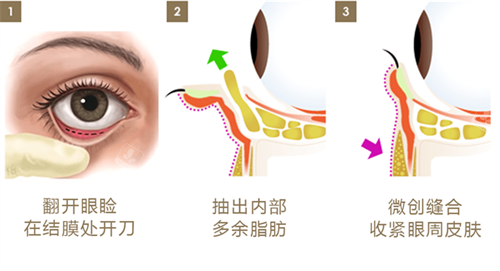 去除脂肪图片