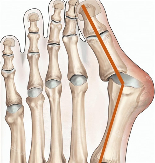 大脚骨的症状展示