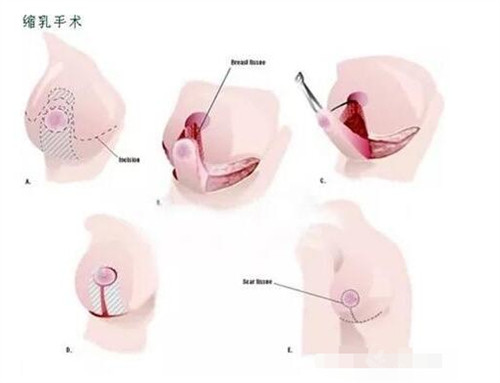 缩乳手术图片