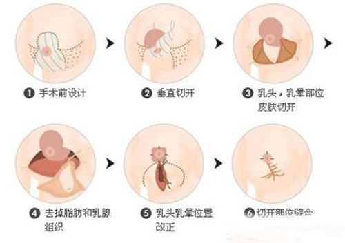 标准乳房缩减手术图片