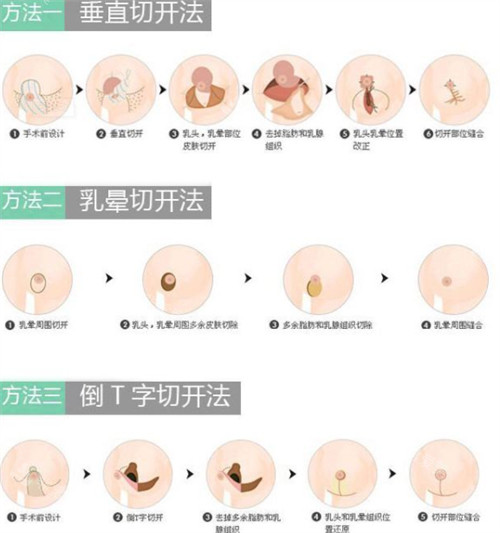 缩乳手术切口方法图片
