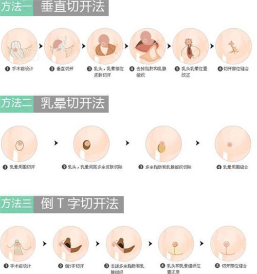 縮乳手術(shù)切口方法圖片