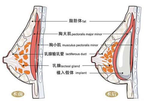 假體隆胸前后對(duì)比圖