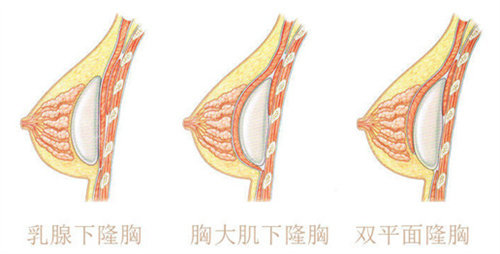 假体隆胸方式